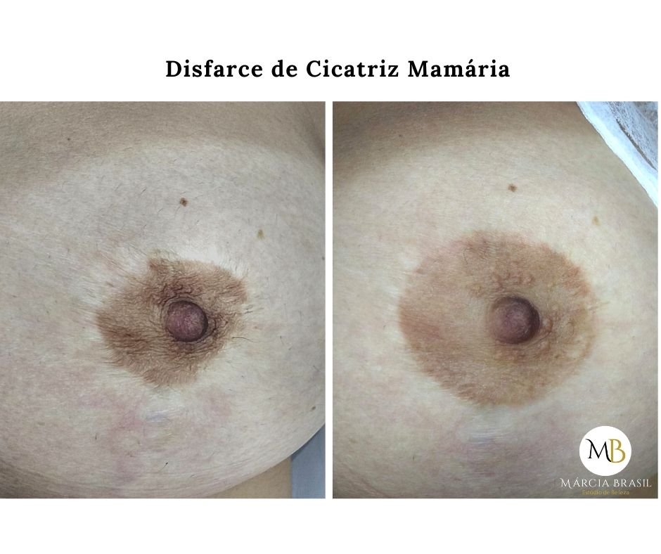Resultado da camuflagem de cicatrizes em mamoplastia