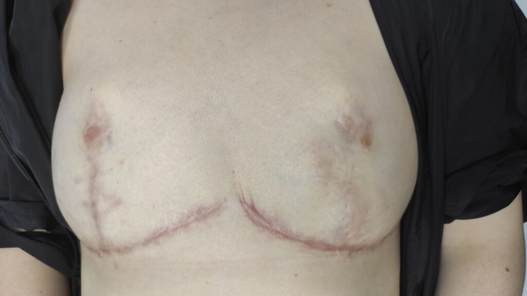 Após mamoplastia com necrose areolar.