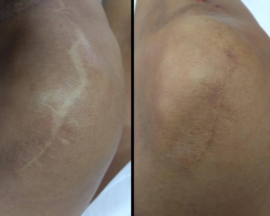 Camuflagem de cicatrizes antes e depois