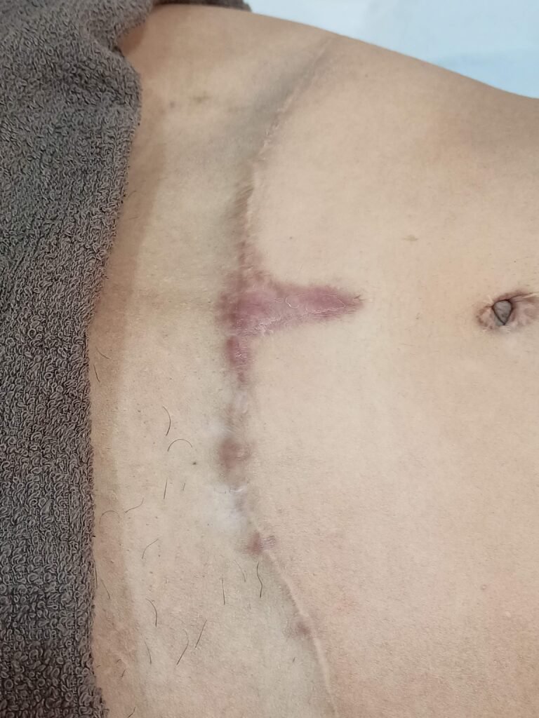 Camuflagem de cicatriz abdominal