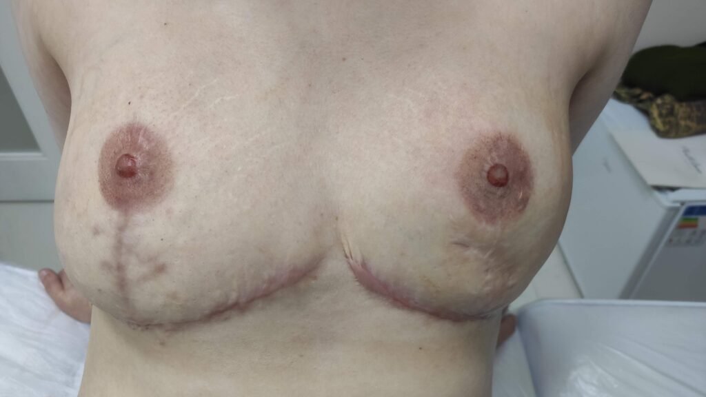 Realismo 3D em areolas.